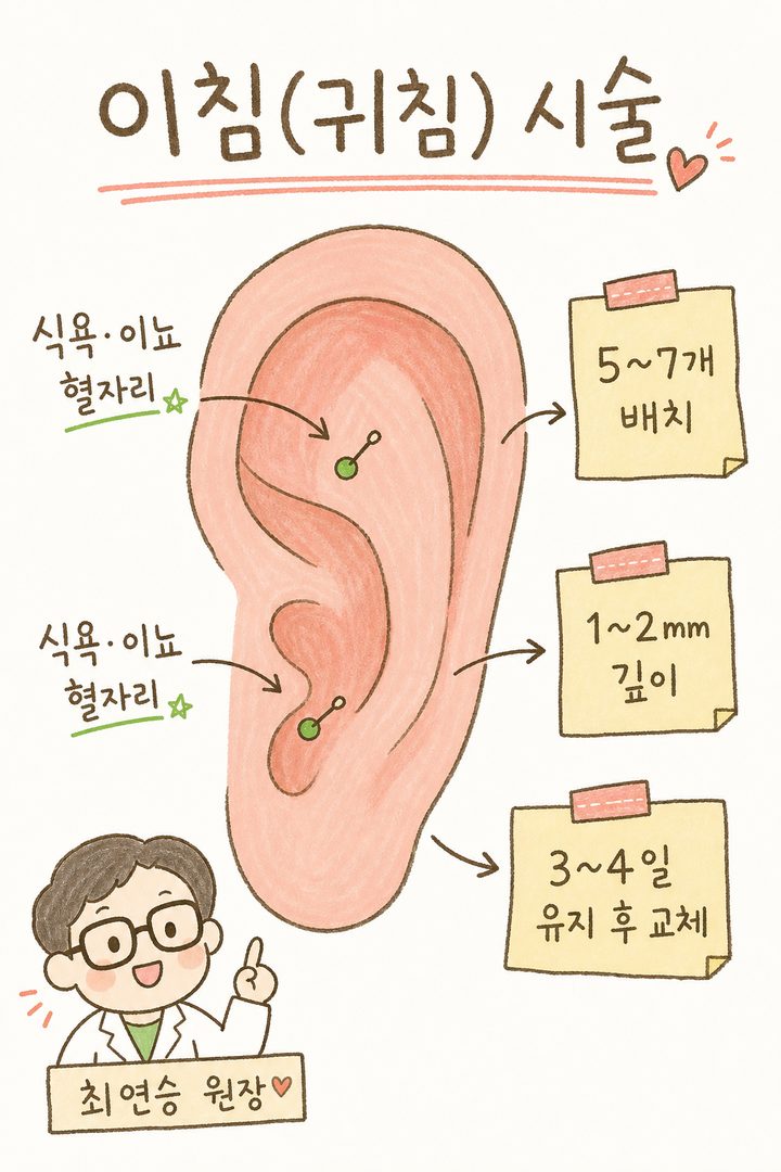 귀 침(이침) 시술 부위 설명 라벨 컷. 귀의 옆모습을 크게 그리고, 식욕·이뇨 혈자리 위치에 화살표를 그어서 시술 정보를 라벨로 표기. 침 개수, 깊이, 유지 기간 등의 실무 정