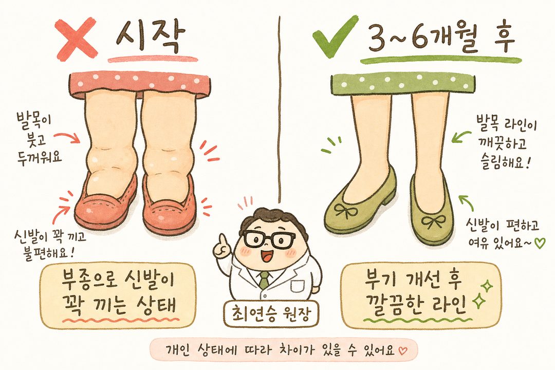 Before/After 비교 이미지. 좌측(❌): 저녁에 부어있는 다리, 신발이 꽉 끼는 불편함 표현. 우측(✅): 부종 개선된 날씬한 라인, 편한 상태. 색상 대비로 명확한 효과